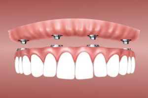 Можно ли восстановить утраченные зубы за 1 день?, Северо-Восточный Стоматологический Центр №1