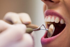Удаление нерва зуба: способы, показания и противопоказания, Северо-Восточный Стоматологический Центр №1