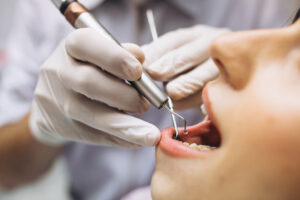 Кариес между зубами: как лечить?