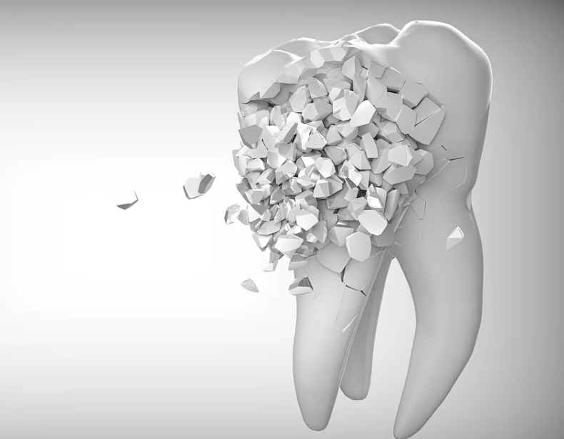 Скол зуба: что делать и как лечить | Причины сколов на зубах, Северо-Восточный Стоматологический Центр №1