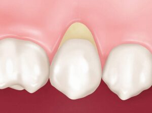 Что такое клиновидный дефект зубов: как вылечить?, Северо-Восточный Стоматологический Центр №1