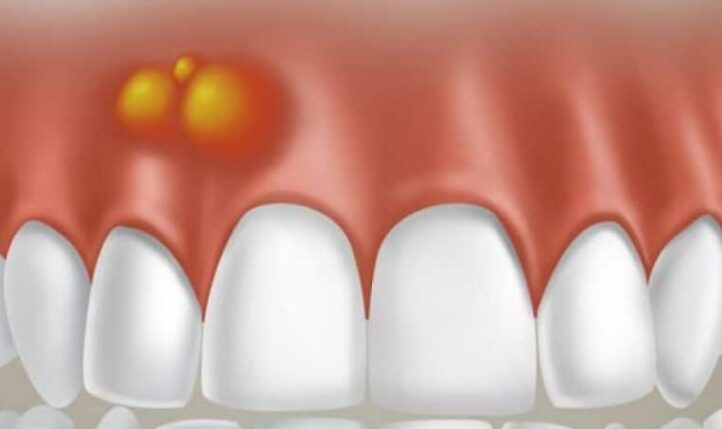 Абсцесс зуба: что это такое — симптомы и лечение