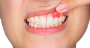 Абсцесс зуба: что это такое - симптомы и лечение