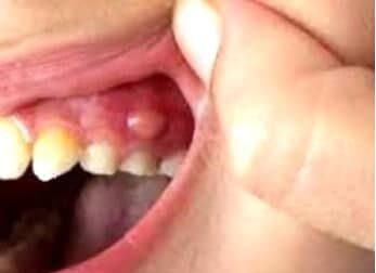 Зубная киста что это — виды и способы лечения
