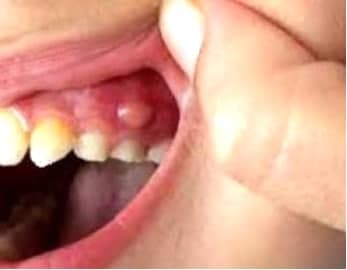 Зубная киста что это — виды и способы лечения, Северо-Восточный Стоматологический Центр №1