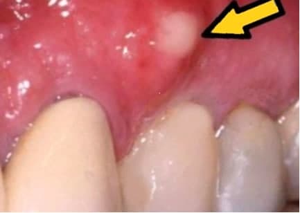 Зубная киста что это — виды и способы лечения, Северо-Восточный Стоматологический Центр №1